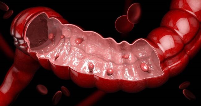 Gastroenterologie POLIPII COLONULUI