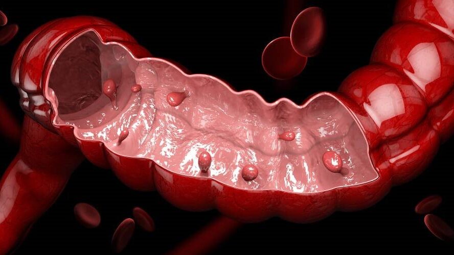 Gastroenterologie POLIPII COLONULUI