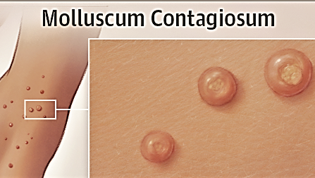 Molluscun-Contagiosum