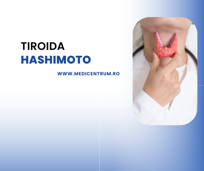 tiroida hashimoto