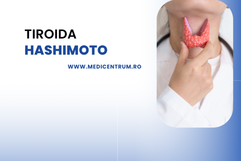 tiroida hashimoto