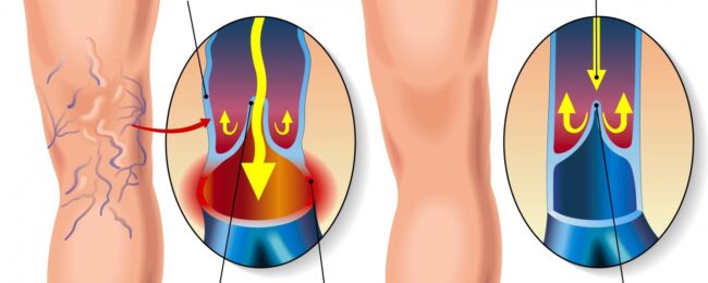 Varicele membrelor inferioare