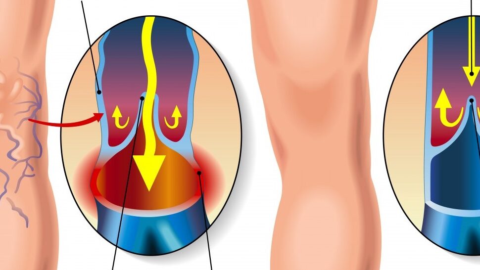 venoasa Varicele membrelor inferioare