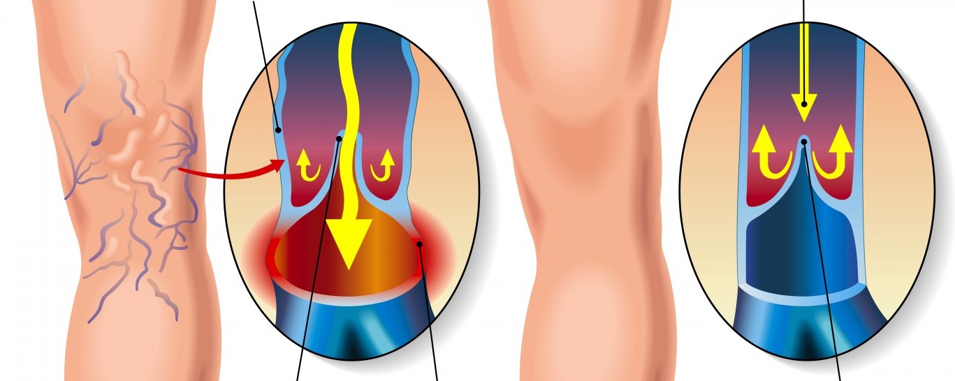Varicele membrelor inferioare